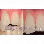 ماده ترمیمی و زیبایی bisico ماده ترمیمی و زیبایی bisico